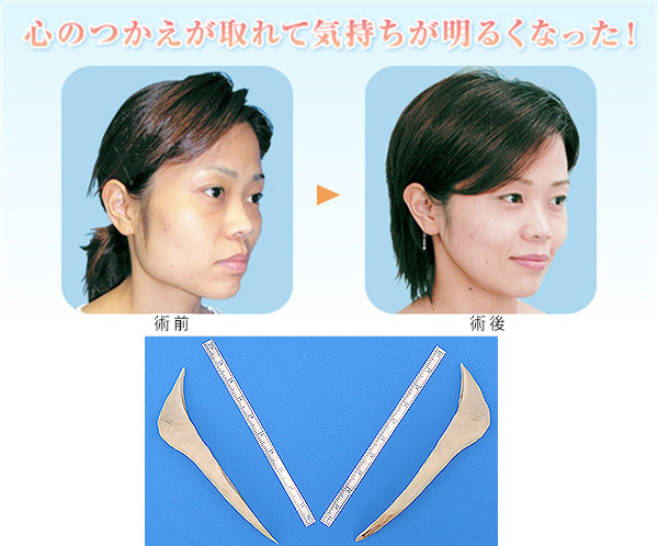 エラ削り