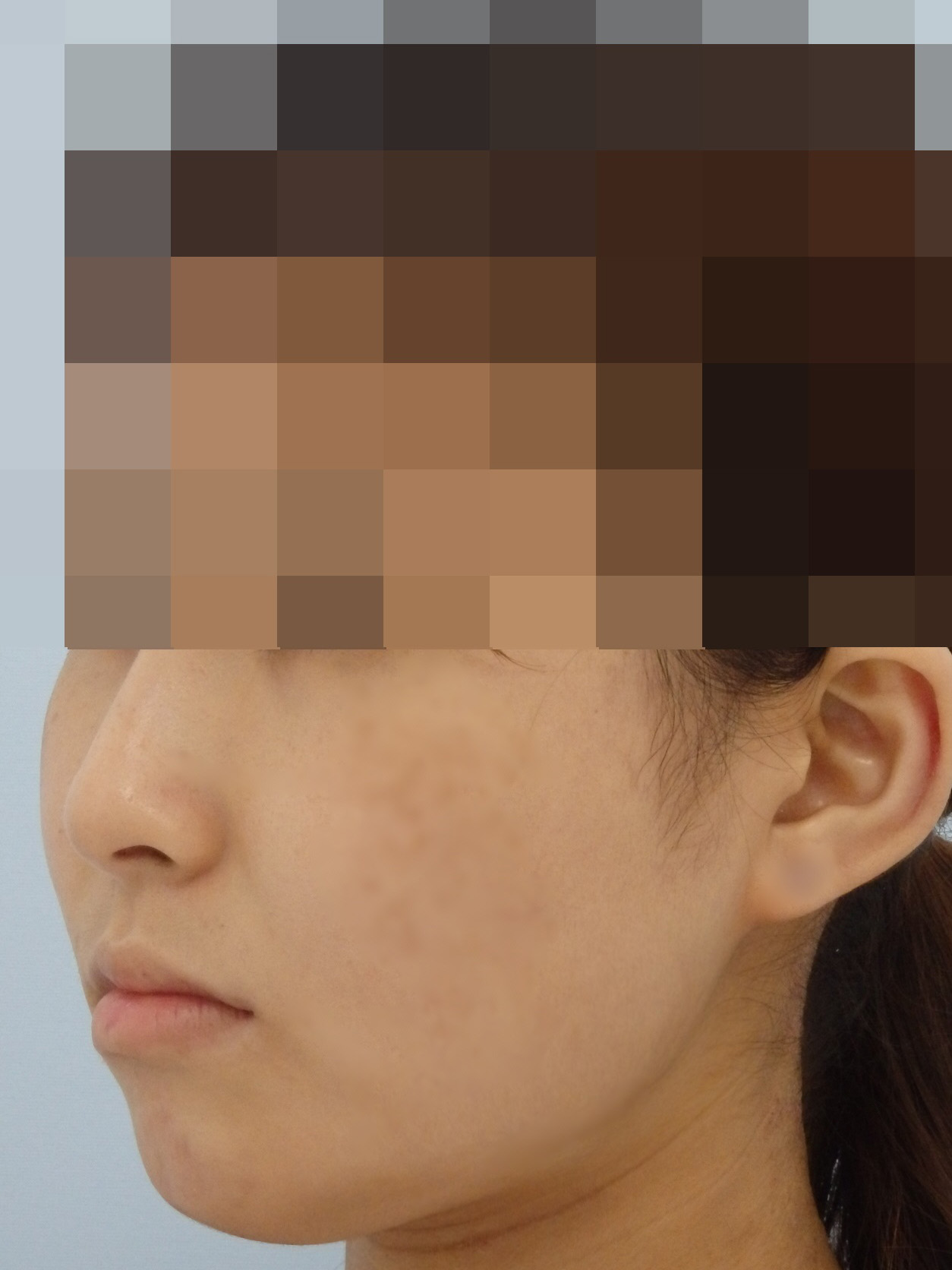 頬削り 日本中から来院される美容外科 小木曽クリニック で頬の整形