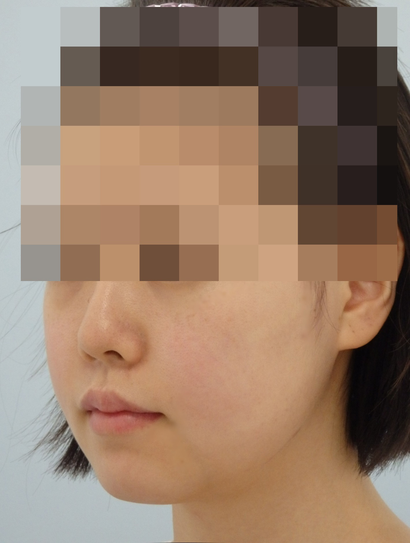 頬削り 日本中から来院される美容外科 小木曽クリニック で頬の整形