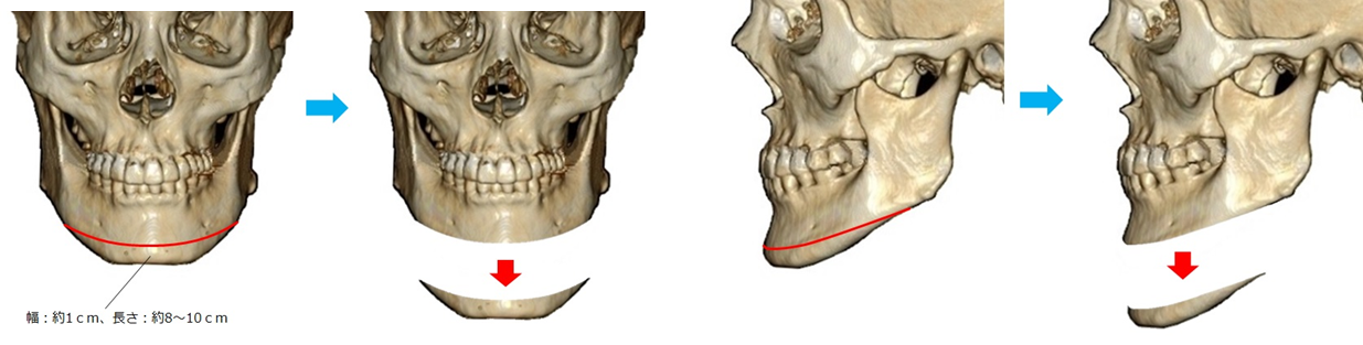 アゴ削り オトガイ形成 美容外科 美容整形の小木曽クリニック